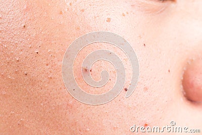 Closed-up of acne, pimples and blackheads on facial skin Stock Photo