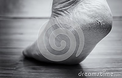 Closed-up of cracked heels, also known as fissures, a common foot problem. black and white tone Stock Photo