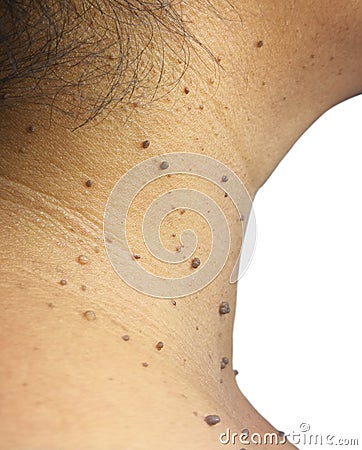 Closed up the skin tags Stock Photo