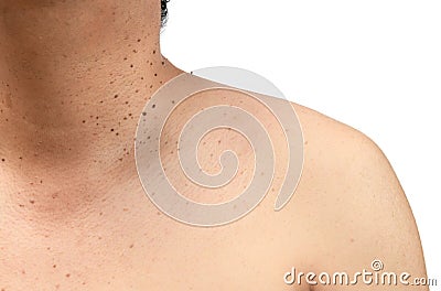 Closed up the skin tags or Seborrheic Keratosis on neck Stock Photo
