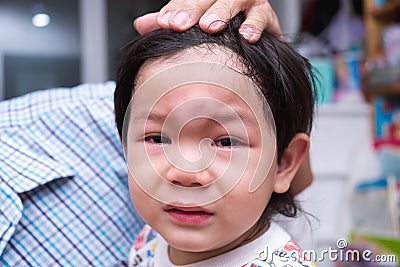 Closeup of Asian boy face sustained a forehead injury from a fall. A 2-3 year old child cries from the pain. A bulging head baby. Stock Photo