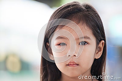 Closeup of asian child girl eye swell from bacteria Stock Photo