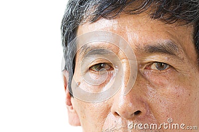 Closeup asian old man eye , his eyes are Pinguecula. Stock Photo