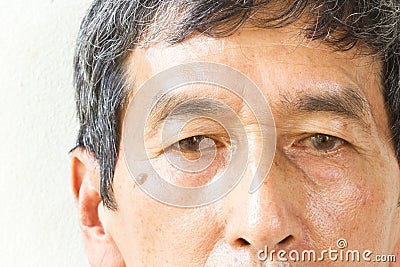 Closeup asian old man eye , his eyes are Pinguecula. Stock Photo