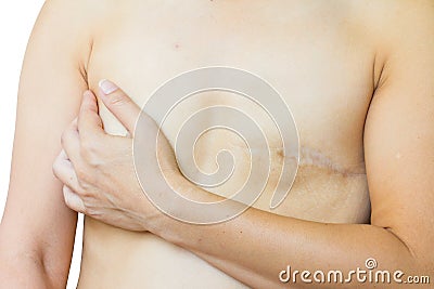 Closeup asian woman with big scar after breast surgery, breast c Stock Photo