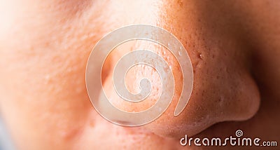 Woman large pores have freckles cheek oily, acne pimple on nose Stock Photo