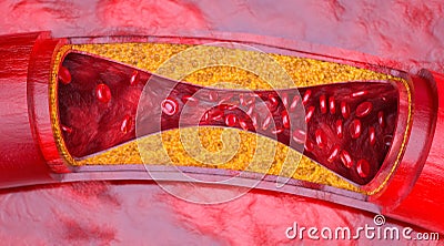 Closeup of a atherosclerosis- 3D rendering Stock Photo