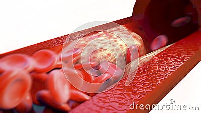 Closeup of a atherosclerosis- 3D rendering Stock Photo