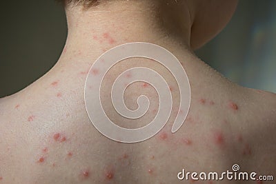 Closeup of boys back full of blisters Stock Photo