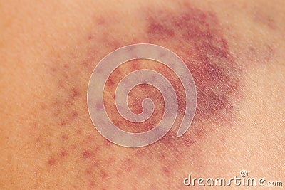 Closeup Bruise on leg skin Stock Photo