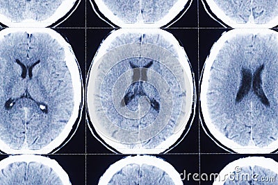 Closeup of computerized tomography of brain, xray film for doctor examination. Stock Photo