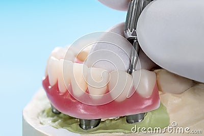 Dental implants supported overdenture. Stock Photo