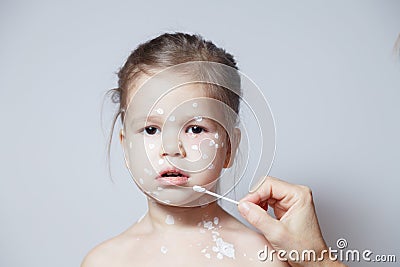 Closeup face of cute little girl with varicella virus or chickenpox bubble rash, doctor`s or mom`s hand with cotton swab coverin Stock Photo