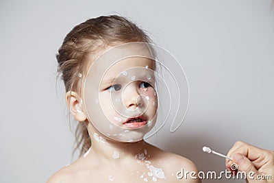 Closeup face of cute little girl with varicella virus or chickenpox bubble rash, doctor`s or mom`s hand with cotton swab coverin Stock Photo