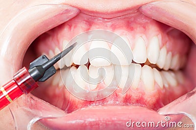 Closeup of front view of patient teeth durring treatment Stock Photo