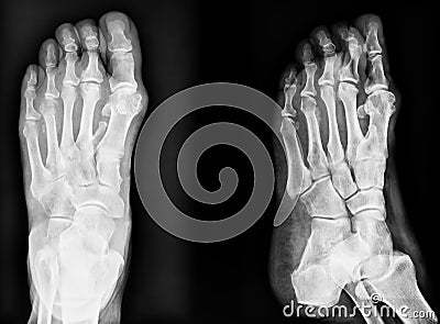 Closeup image of classic xray image of feet. Black and white. Stock Photo