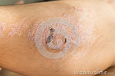 Closeup on injured knee with scar from abrasion healing Stock Photo