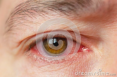 Closeup irritated infected red bloodshot eyes, conjunctivitis Stock Photo