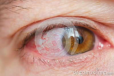 Closeup irritated infected red bloodshot eyes, conjunctivitis Stock Photo