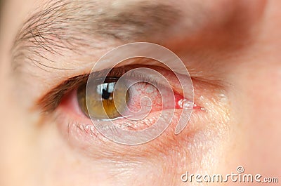 Closeup irritated infected red bloodshot eyes, conjunctivitis Stock Photo