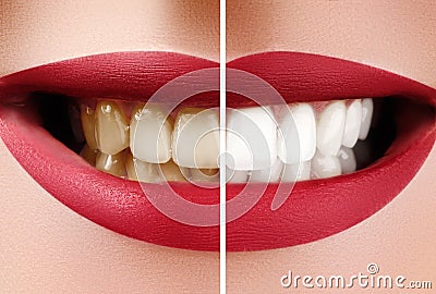 Closeup Macro of Female Teeth Before and After Whitening. Dental Health and Oral Care Concept. Happy Smile with Red Lips Stock Photo