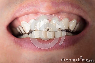 Man Wearing Transparent Teeth Aligners Stock Photo