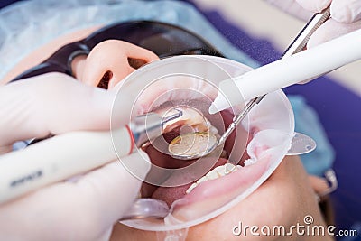 Closeup of modern professional teeth cleaning in dentistry with specialized equipment. Stock Photo