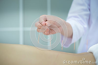 Closeup, patient getting acupuncture from acupuncturis Stock Photo