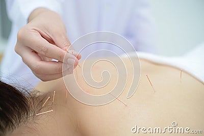 Closeup, patient getting acupuncture from acupuncturist Stock Photo