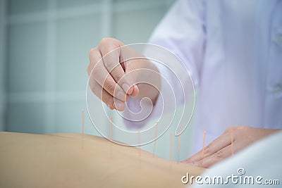 Closeup, patient getting acupuncture from acupuncturist Stock Photo