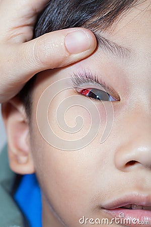 Closeup of Pinkeye (conjunctivitis) infection on a boy, doctor c Stock Photo