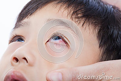 Closeup pinkeye (conjunctivitis) infection Stock Photo