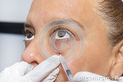 Closeup Of Platelet Rich Plasma PRP Cosmetic Therapy Near A Woman`s Eyes, Being Injected With Needle Poking Stock Photo