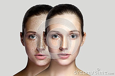 Closeup before and after portrait of beautiful brunette woman after laser treatment removing freckles on face looking at camera. Stock Photo