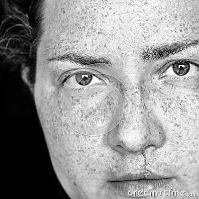 Closeup Portrait of Caucasian Woman with Freckles and Cleft Lip Looking Directly at Camera. Image is in Black and White Stock Photo