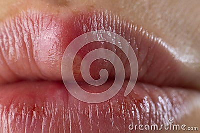 Closeup of Red bubbles of virus herpes on lips. Selective focus. Zoster, Cold, Medicine, Treatment. Horizontal Macro shot Stock Photo