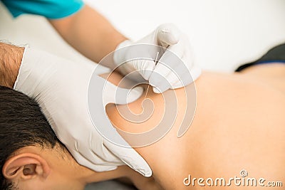 Shirtless Man Receiving Dry Needling Therapy From Doctor Stock Photo