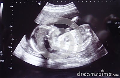 Closeup shot of an obstetric ultrasonography Stock Photo