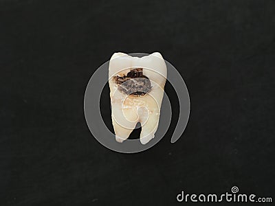 Closeup single bad tooth with caries big hole on black background. Unhealthy teeth Stock Photo