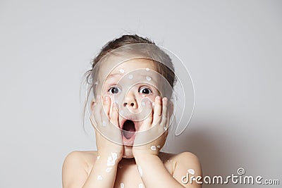 Closeup surprized cute little girl with varicella virus or chickenpox bubble rash, conjunctivitis, sore eyes, red spots covered Stock Photo