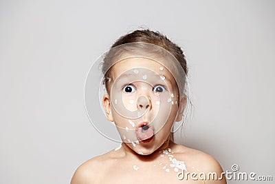 Closeup surprized cute little girl with varicella virus or chickenpox bubble rash, conjunctivitis, sore eyes, red spots covered Stock Photo