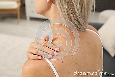 Closeup view of woman`s body with birthmarks indoors Stock Photo