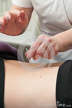 Closeup of a woman getting an acupuncture treatment Stock Photo