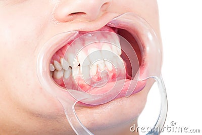 Closeup of woman mouth with plastic retractor Stock Photo