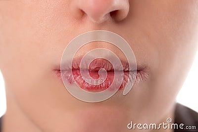 Closeup womanÂ´s face with brittle and dry lips, concept lip sal Stock Photo