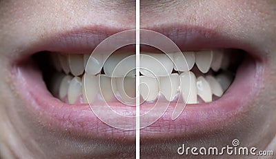 Teeth whitening before after Stock Photo