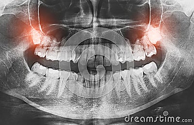 Closeup of x-ray image growing wisdom teeth pain concept. Cartoon Illustration