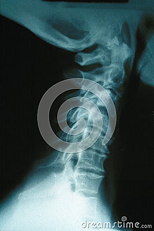 Closeup Xray of Human Neck Stock Photo