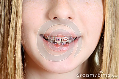 Closeup young girl with braces Stock Photo