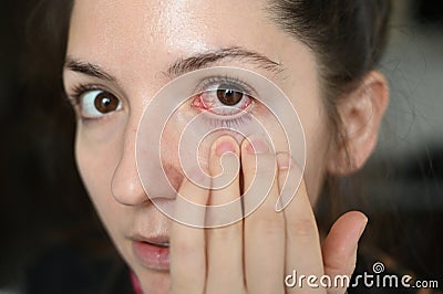 Closeup of young woman with red inflamed and dilated capillaries eye. Allergy, conjunctivitis, inflammation Stock Photo